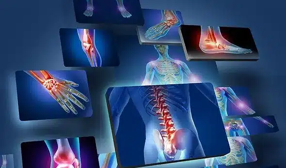 Arthritis of joints